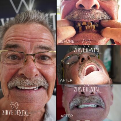 Zirve Dental Marmaris