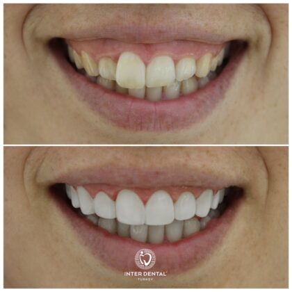 Inter Dental Turkey