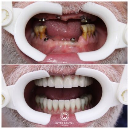 Inter Dental Turkey