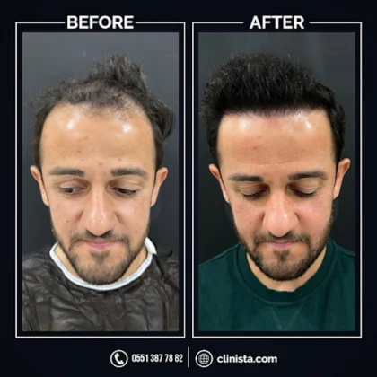 Clinista Hair Transplant Center Clinista Hair Transplant Center