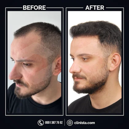 Clinista Hair Transplant Center Clinista Hair Transplant Center