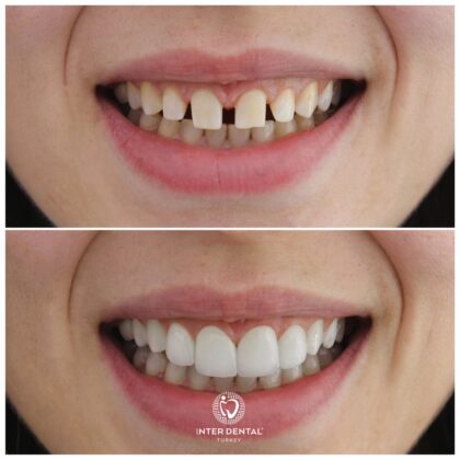 Inter Dental Turkey