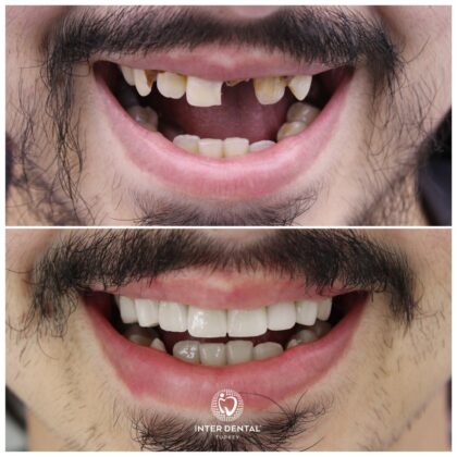 Inter Dental Turkey