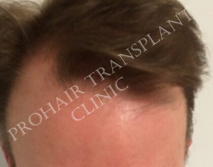Prohair Transplant Clinic Budapest