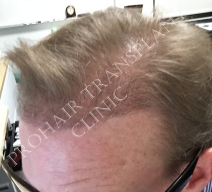 Prohair Transplant Clinic Budapest