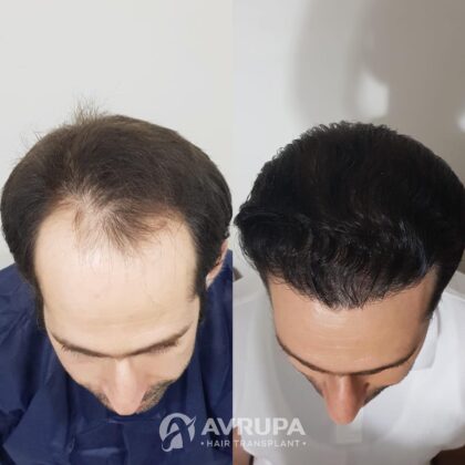 Avrupa Saç Ekimi Clinic