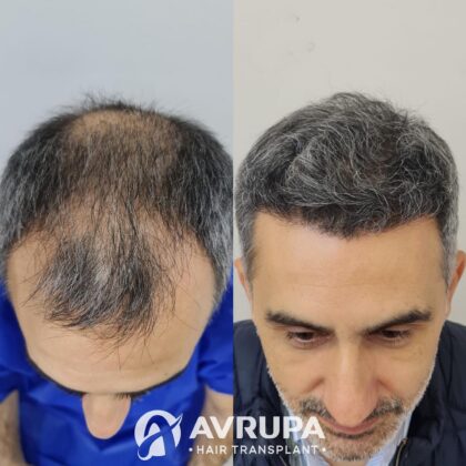 Avrupa Saç Ekimi Clinic