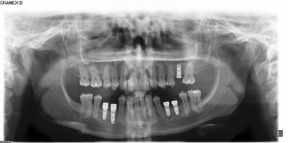 Dental Implants Costa Rica Dr. Jairo Vargas Clinic