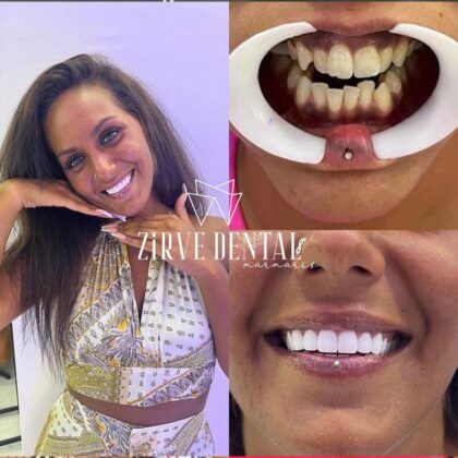 Zirve Dental Marmaris