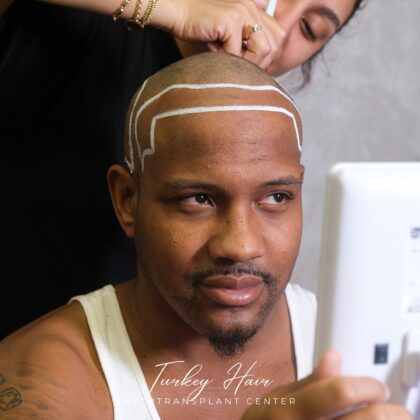 Turkey Hair Transplant Center Turkey Hair Transplant Center
