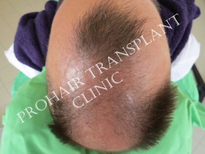 Prohair Transplant Clinic Budapest