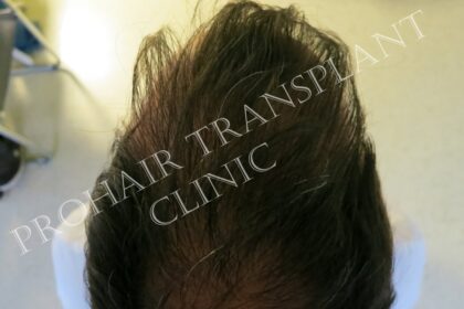 Prohair Transplant Clinic Budapest