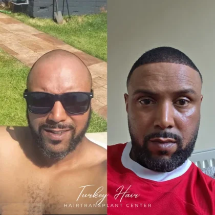 Turkey Hair Transplant Center Turkey Hair Transplant Center