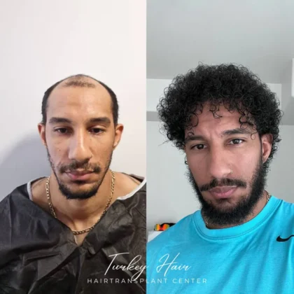 Turkey Hair Transplant Center Turkey Hair Transplant Center