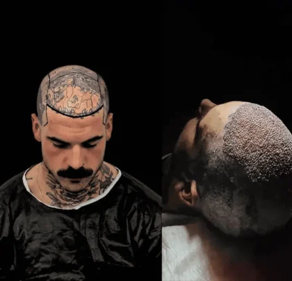 Turkey Hair Transplant Center Turkey Hair Transplant Center