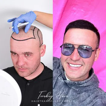Turkey Hair Transplant Center Turkey Hair Transplant Center