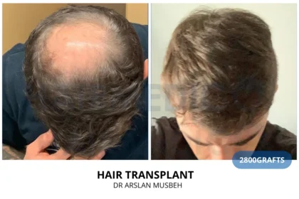 Hairmedico