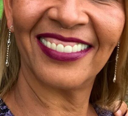 Dental Implants Costa Rica Dr. Jairo Vargas Clinic