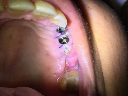 Dental Implants Costa Rica Dr. Jairo Vargas Clinic