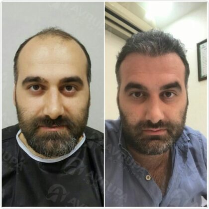 Avrupa Saç Ekimi Clinic