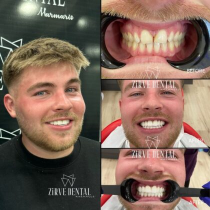 Zirve Dental Marmaris