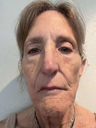Dr Phatcharasak Kraisornphongsakul Md