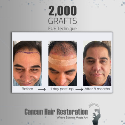 Cancun Hair Restoration