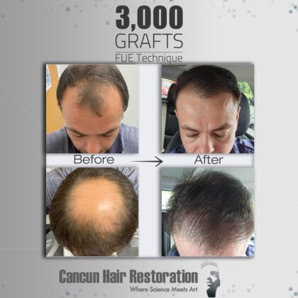 Cancun Hair Restoration