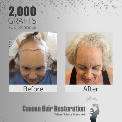 Cancun Hair Restoration