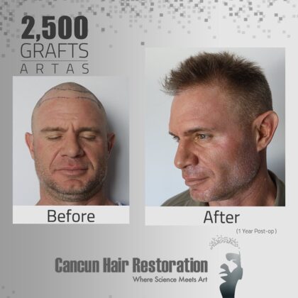Cancun Hair Restoration