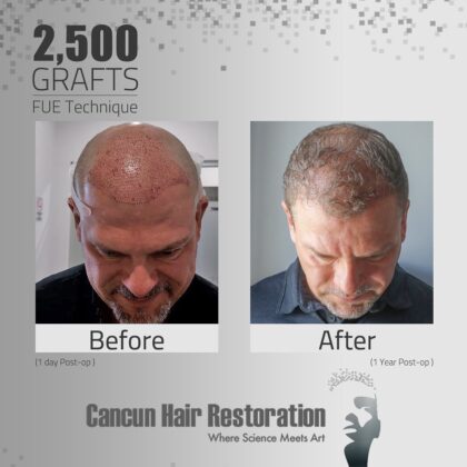 Cancun Hair Restoration
