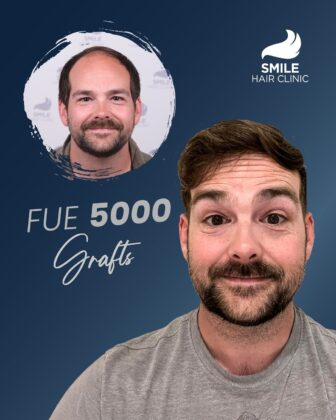 Smile Hair Clinic | Hair Transplant in Turkey
