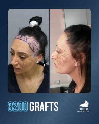 Smile Hair Clinic | Hair Transplant in Turkey