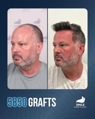 Smile Hair Clinic | Hair Transplant in Turkey