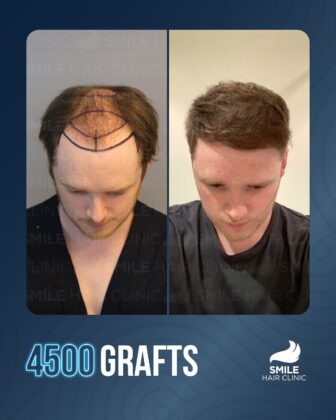 Smile Hair Clinic | Hair Transplant in Turkey