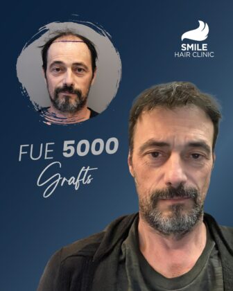 Smile Hair Clinic | Hair Transplant in Turkey
