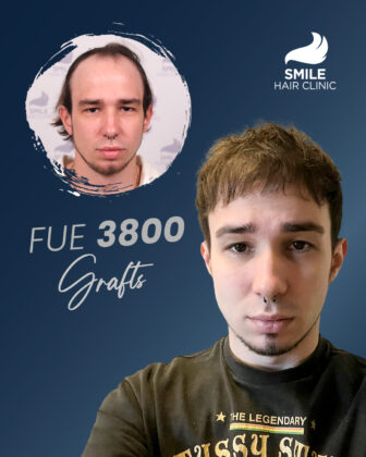 Smile Hair Clinic | Hair Transplant in Turkey