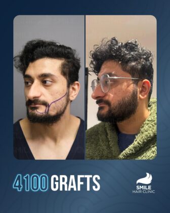 Smile Hair Clinic | Hair Transplant in Turkey
