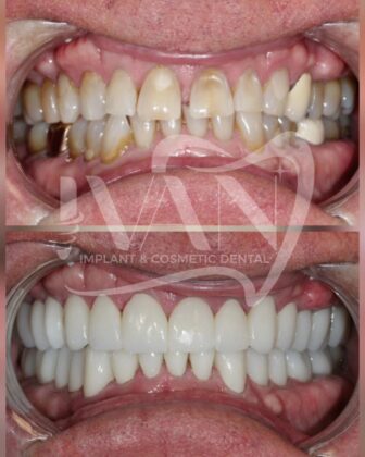 Ivan implant and cosmetic dental