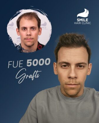 Smile Hair Clinic | Hair Transplant in Turkey