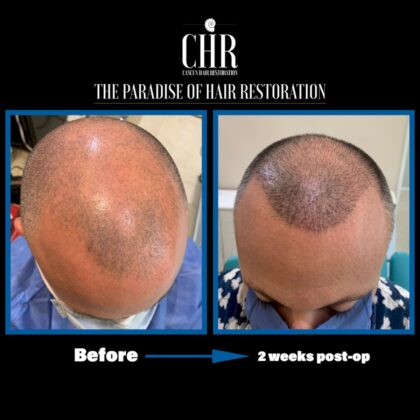 Cancun Hair Restoration