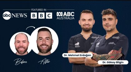 Smile Hair Clinic | Hair Transplant in Turkey