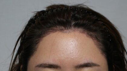 MOAMAN Hair Transplant Clinic