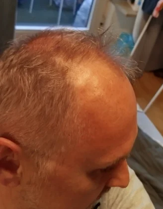 Smile Hair Clinic | Hair Transplant in Turkey