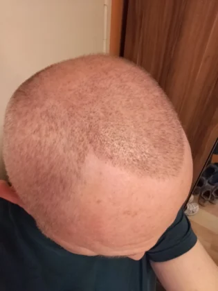 Smile Hair Clinic | Hair Transplant in Turkey