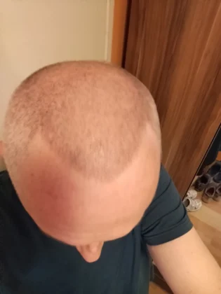 Smile Hair Clinic | Hair Transplant in Turkey