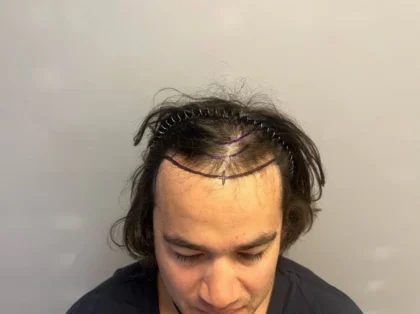Smile Hair Clinic | Hair Transplant in Turkey