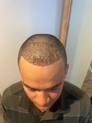 Smile Hair Clinic | Hair Transplant in Turkey