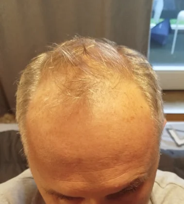 Smile Hair Clinic | Hair Transplant in Turkey