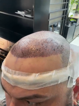 Smile Hair Clinic | Hair Transplant in Turkey
